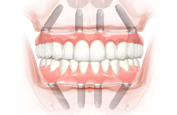 protese tipo protocolo como é feito dr piero brandini implantes e proteses sorocaba